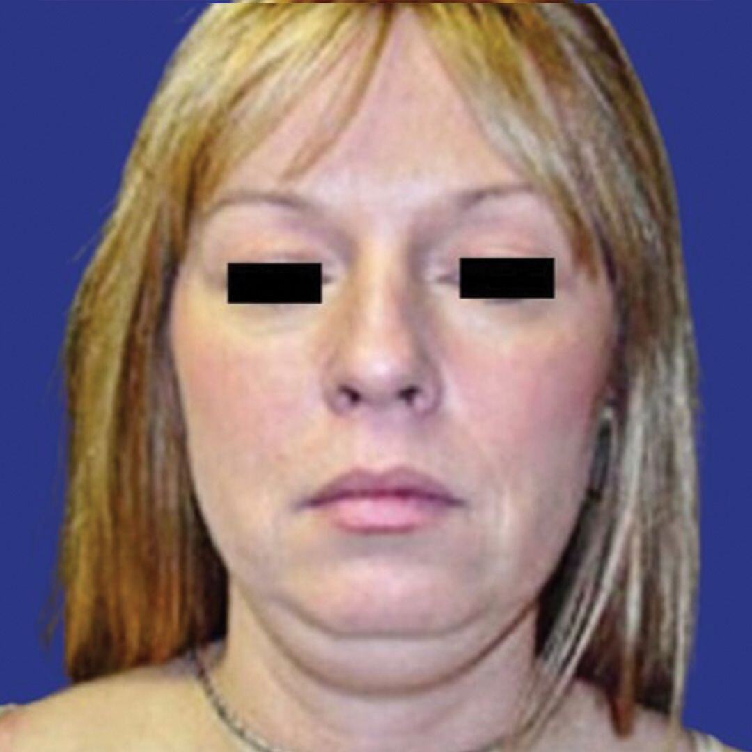 Procedure before and after - before