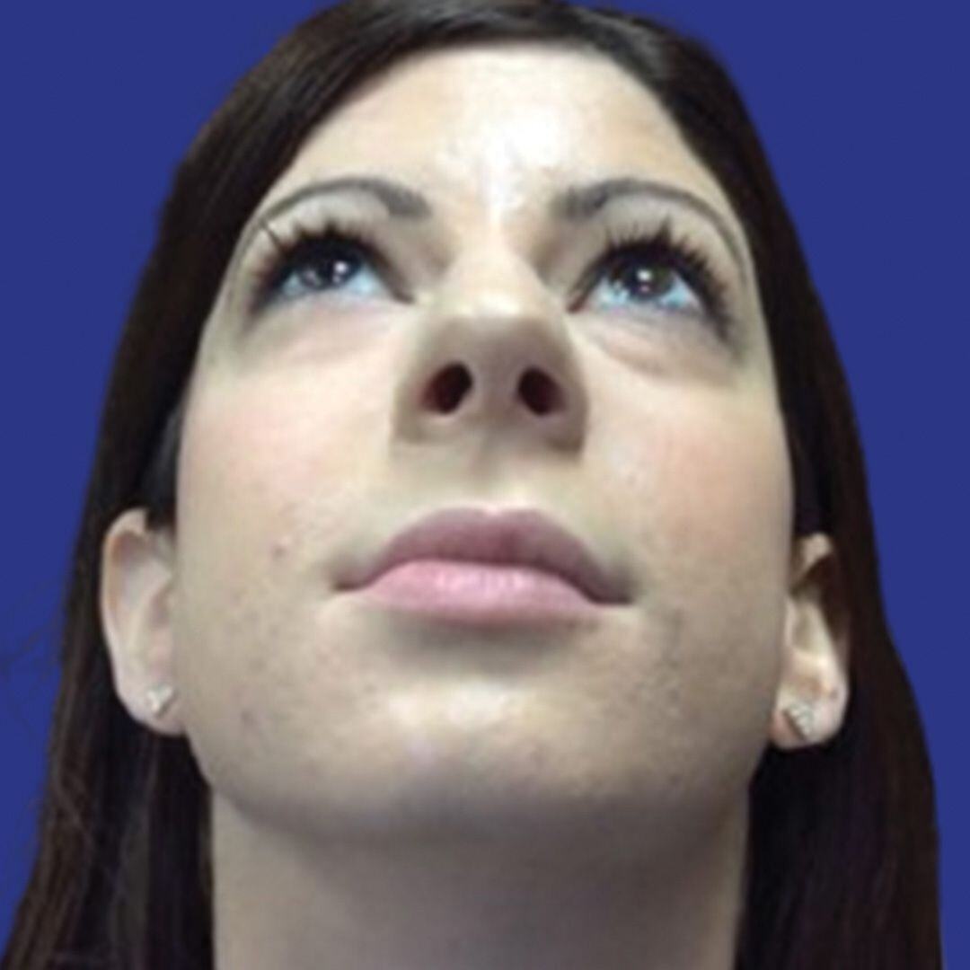 Procedure before and after - before