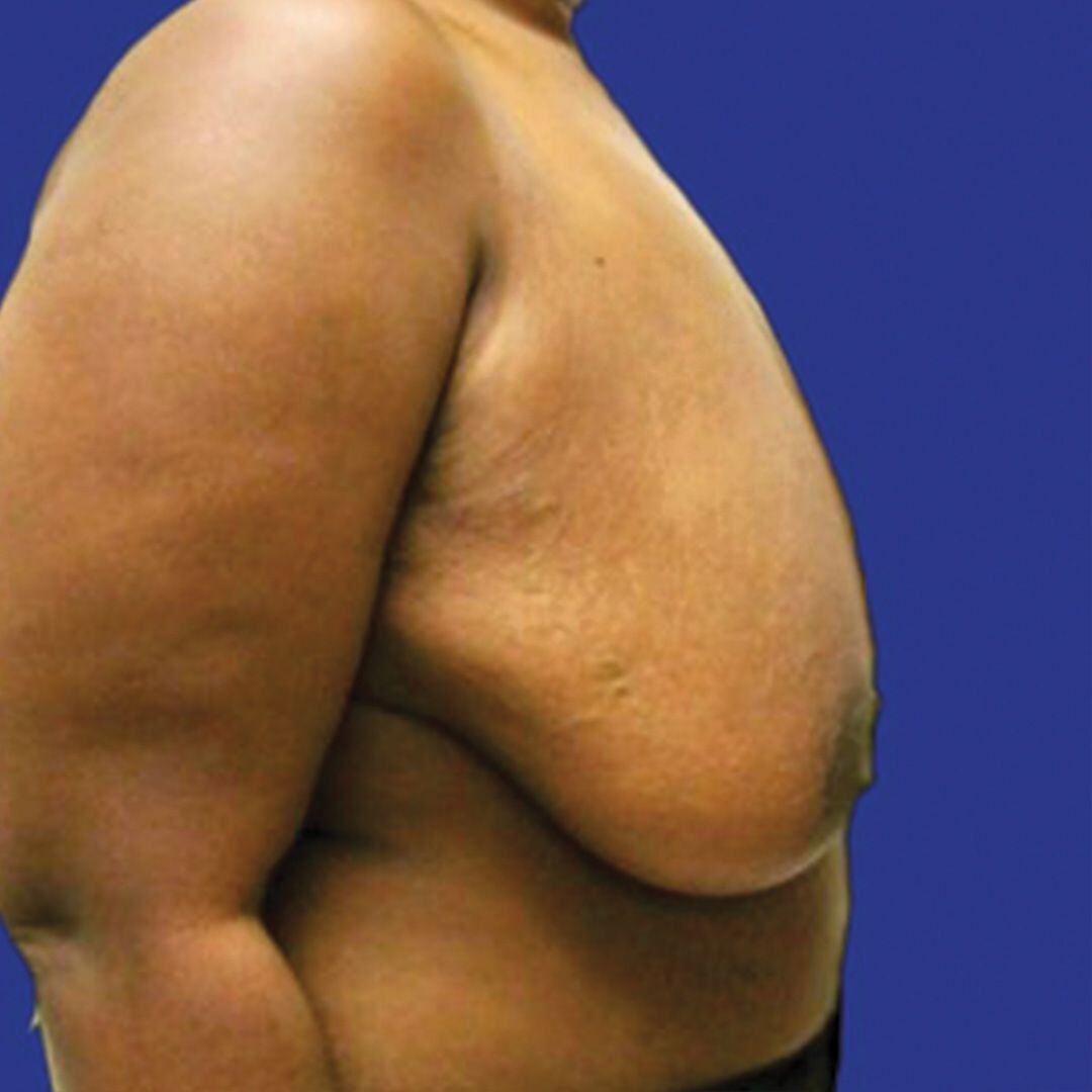 Procedure before and after - before