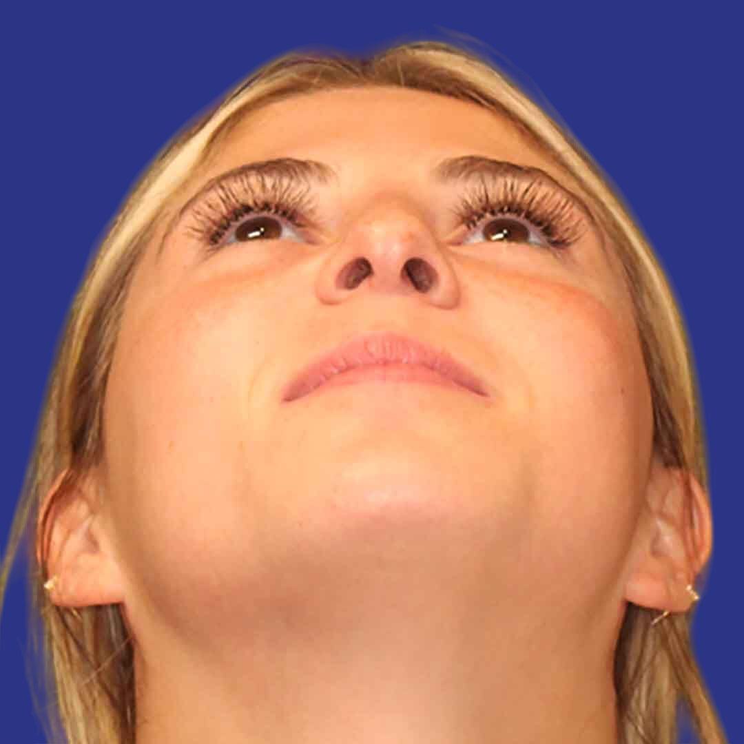 Procedure before and after - before