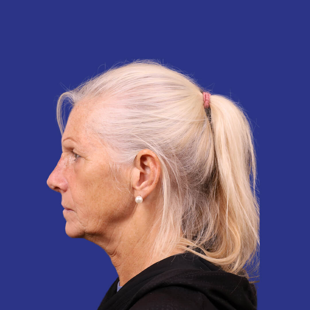 Procedure before and after - before
