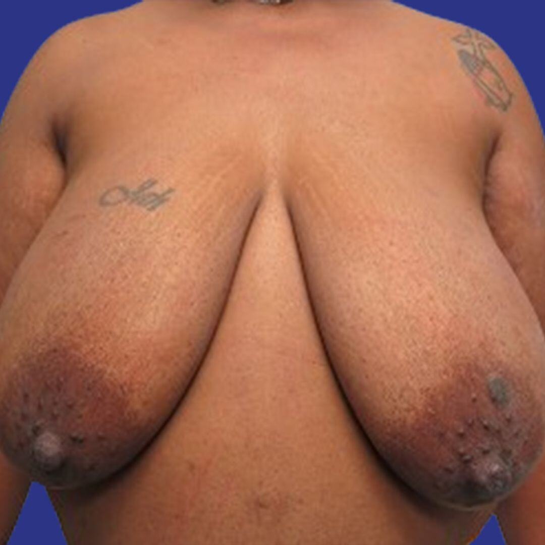Procedure before and after - before