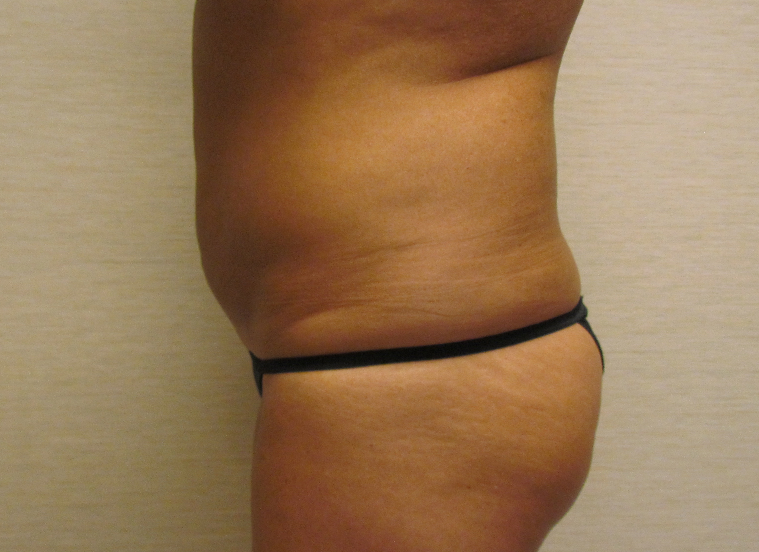 Abdominal Liposuction before and after - after