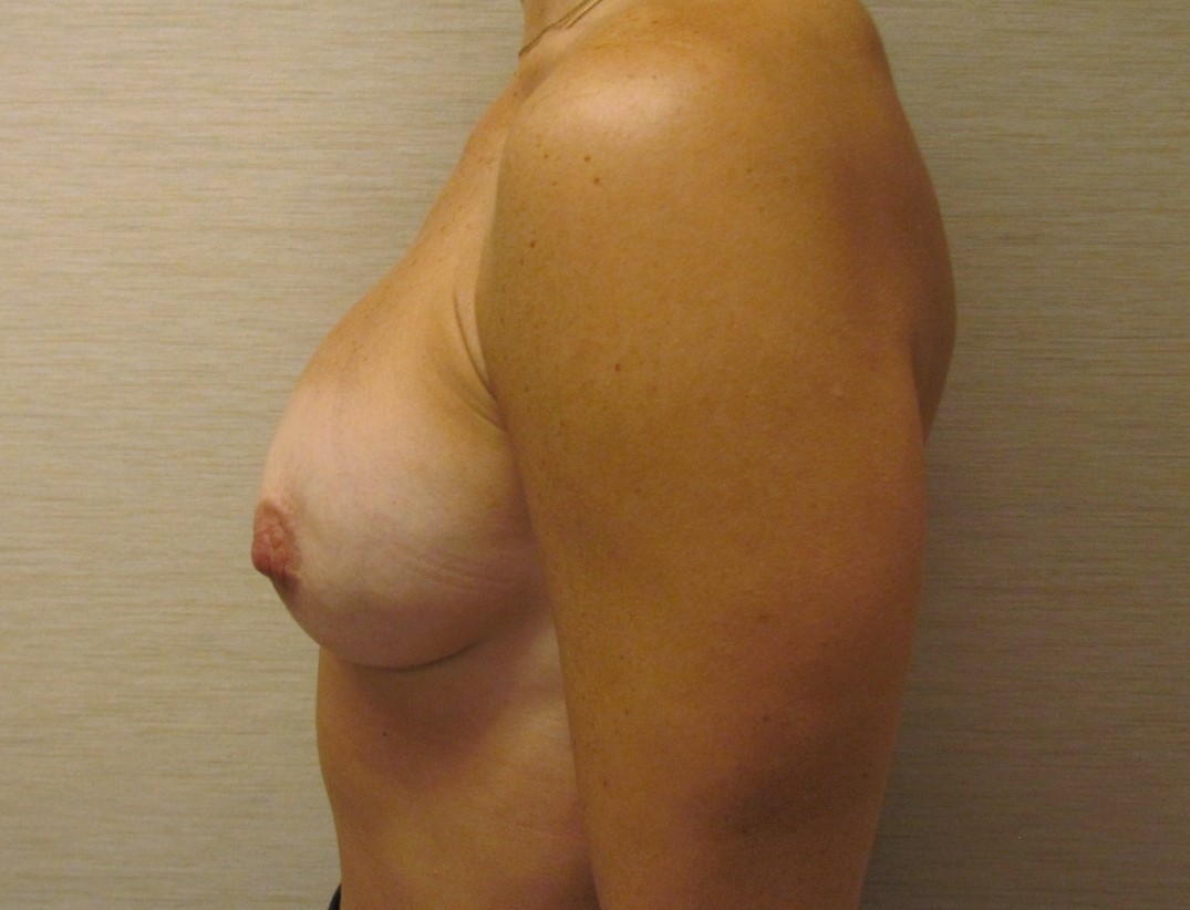 Bilateral Breast Reconstruction using Tissue expansion before and after - after