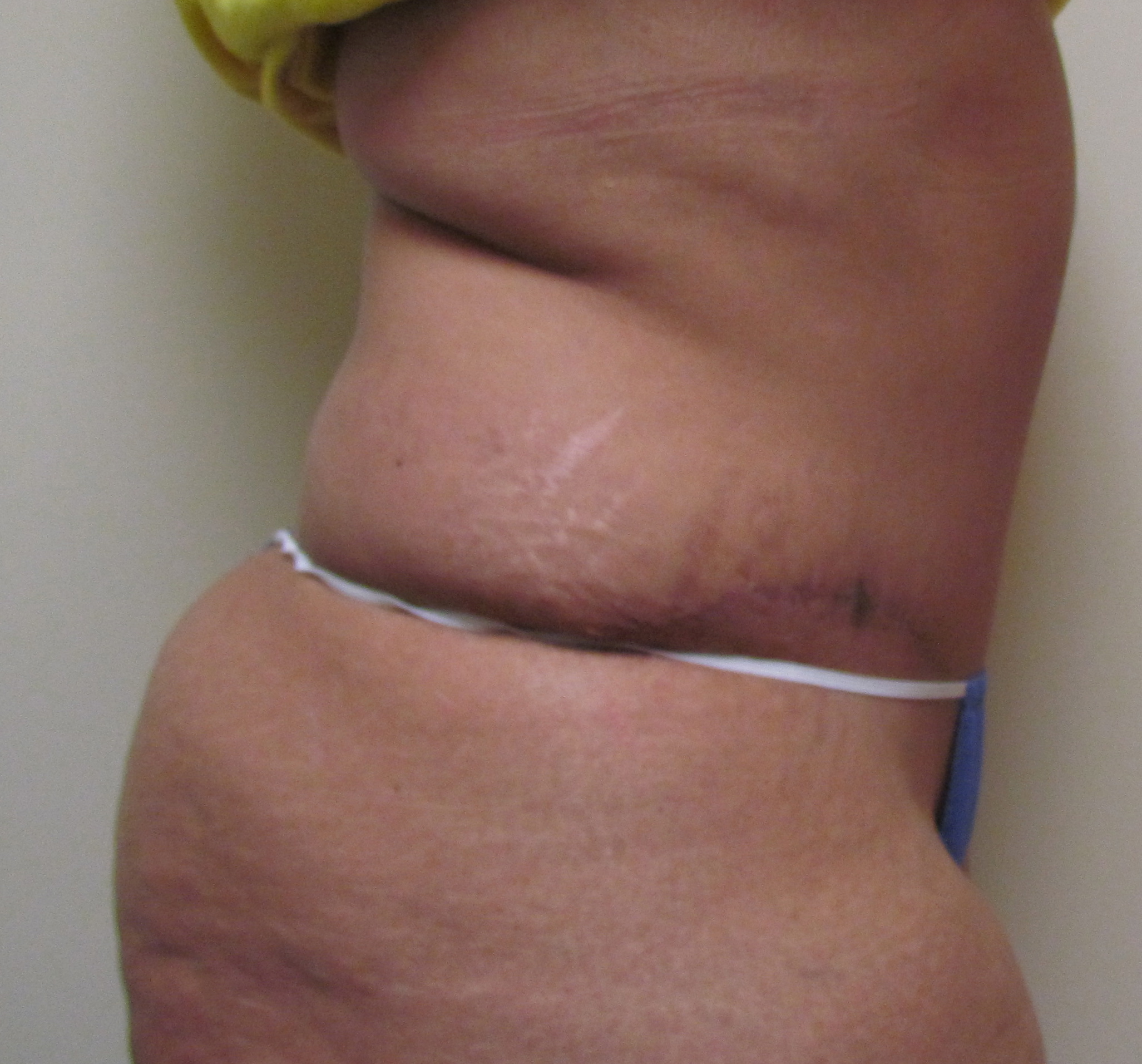 Tummy Tuck with Abdominal Muscle Tightening before and after - after