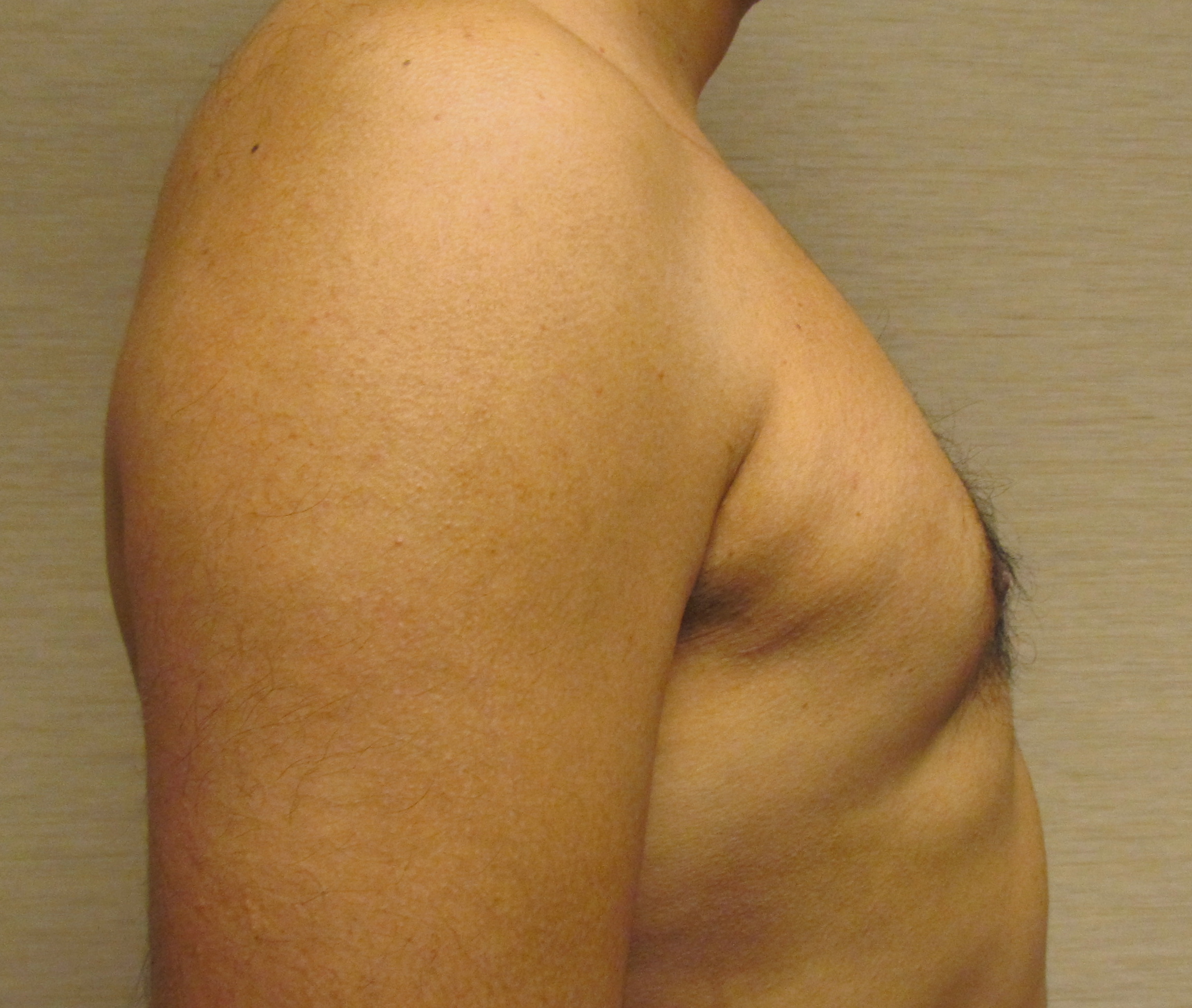 Male Breast Reduction (Gynecomastia Surgery) before and after - after