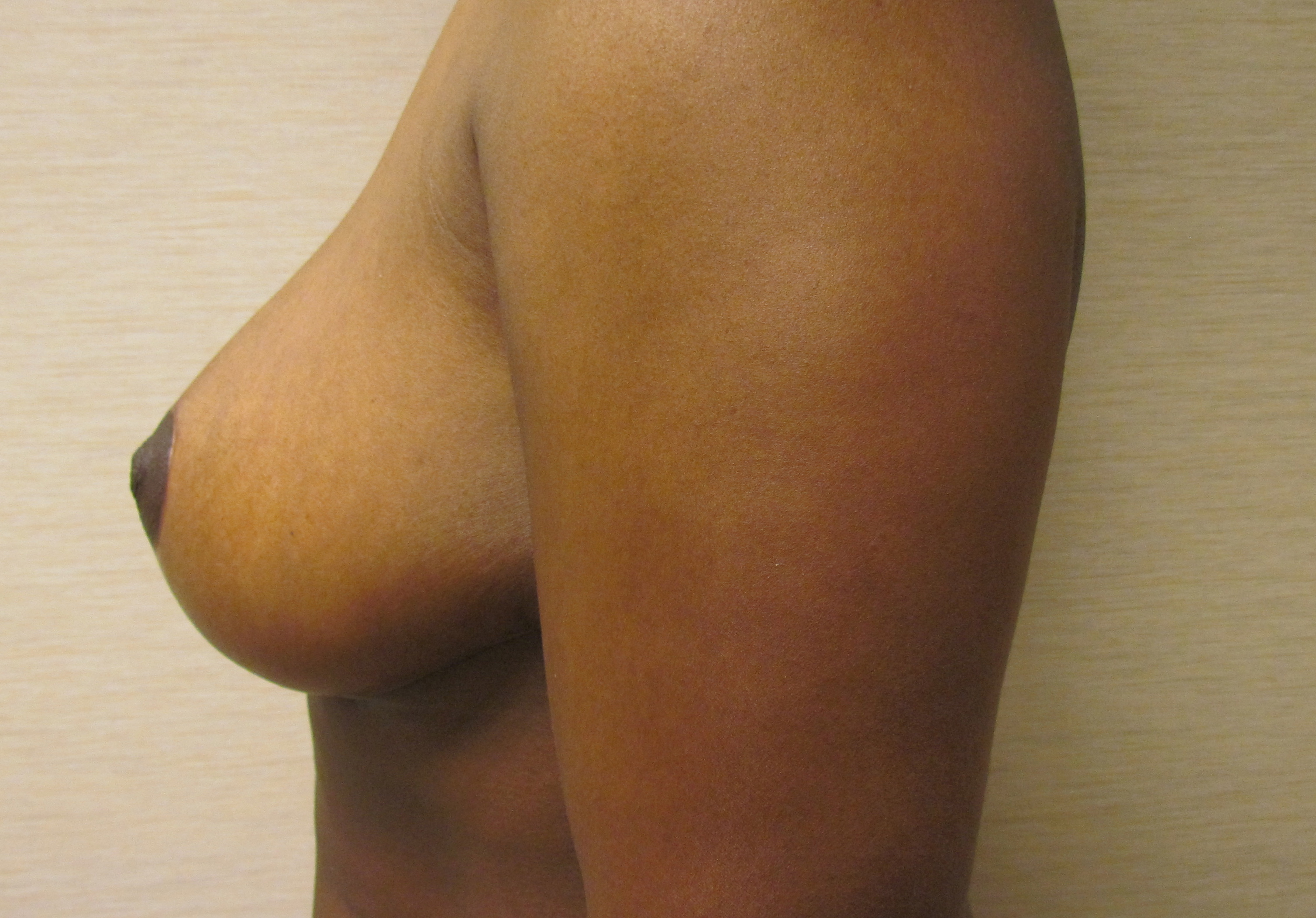 Bilateral Breast Reduction before and after - after