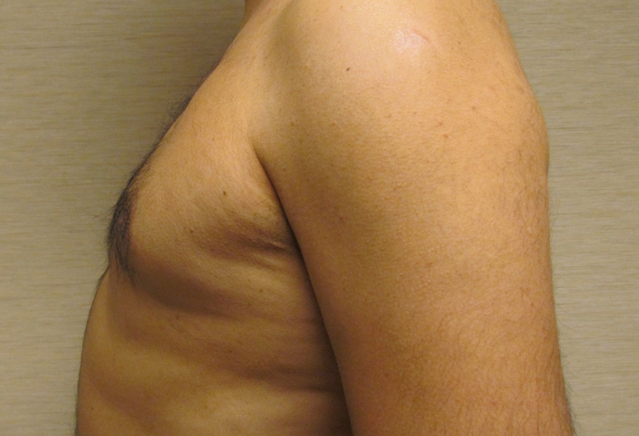 Male Breast Reduction (Gynecomastia Surgery) before and after - after