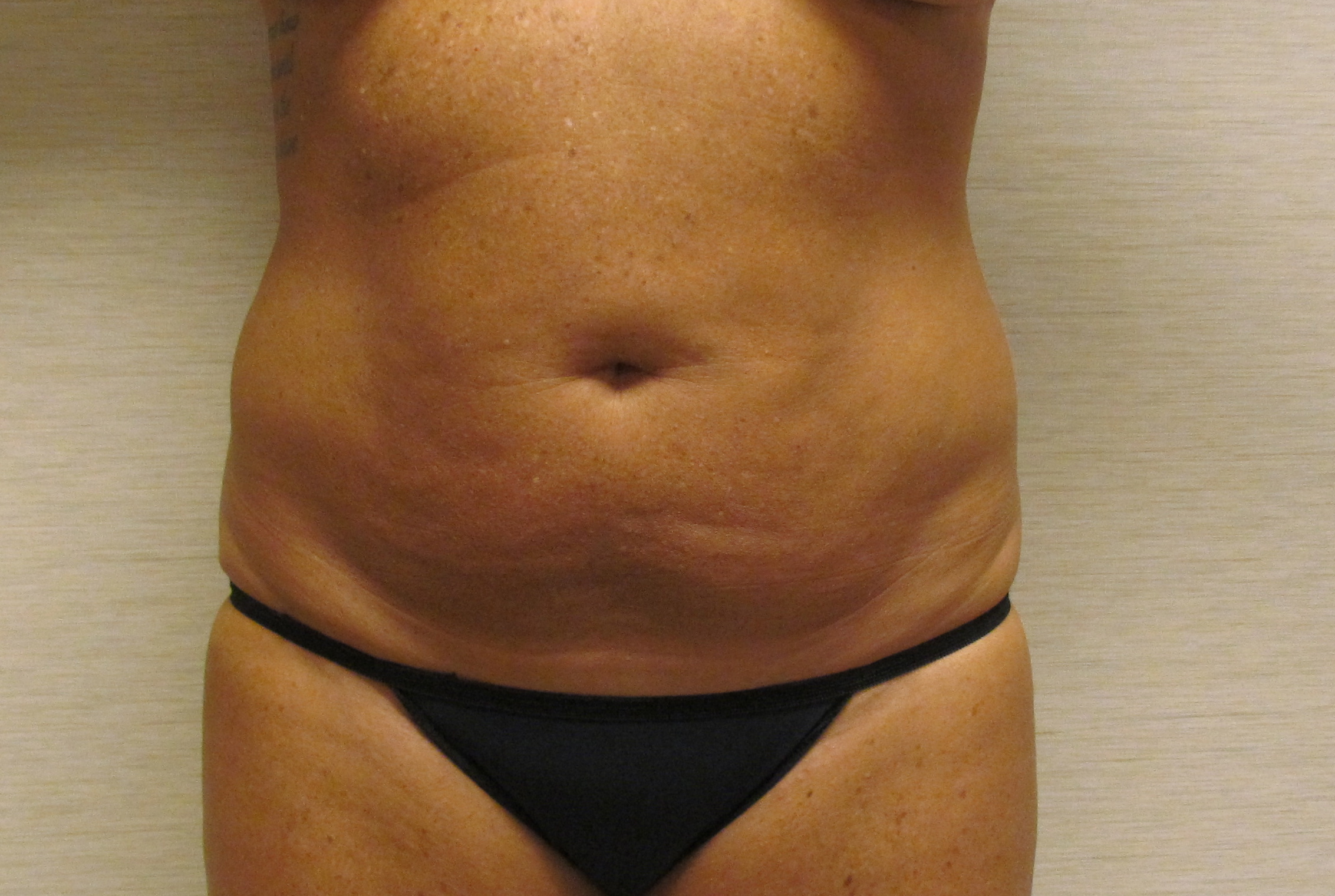 Liposuction before and after - after