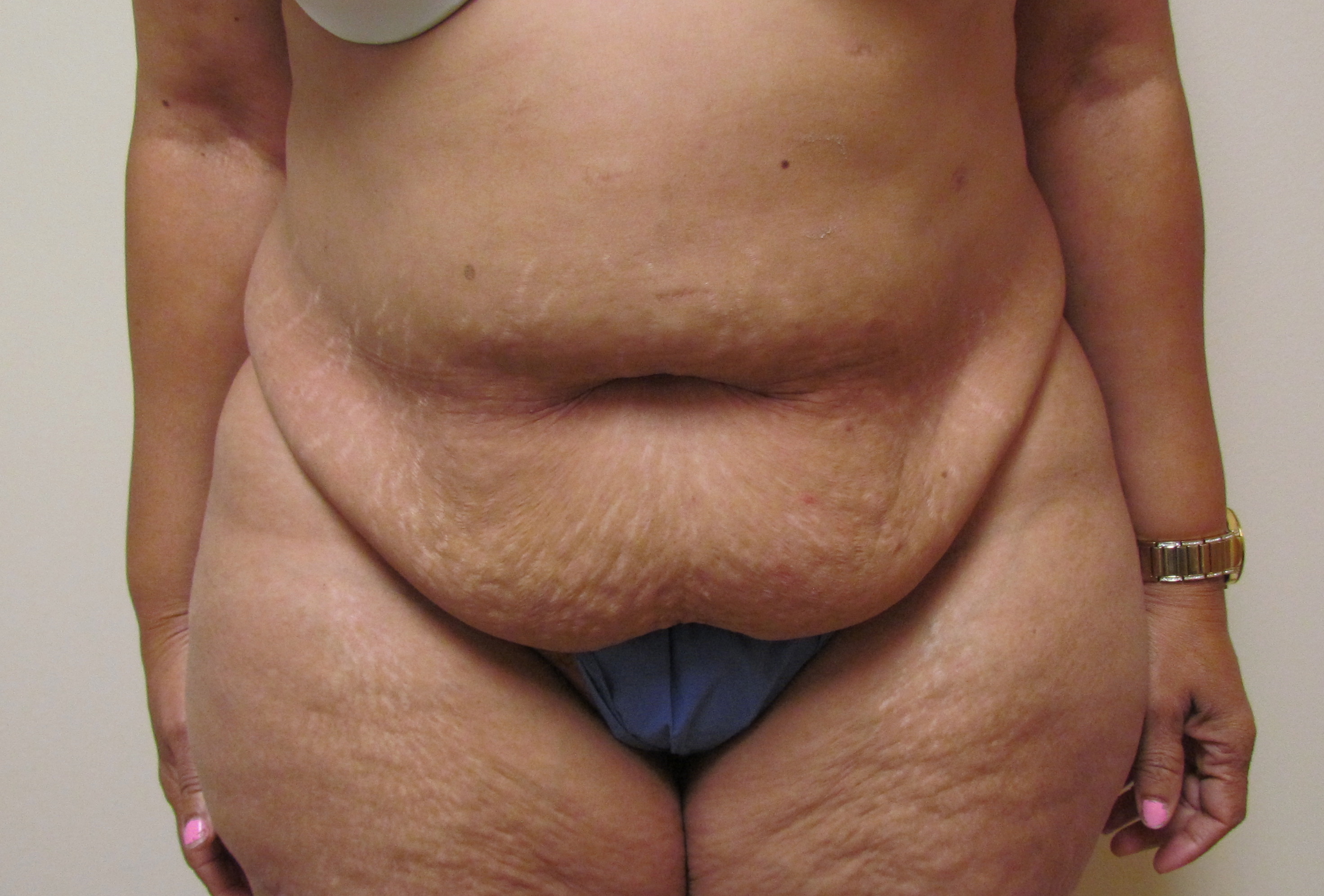 Abdominoplasty (Tummy Tuck) before and after - after