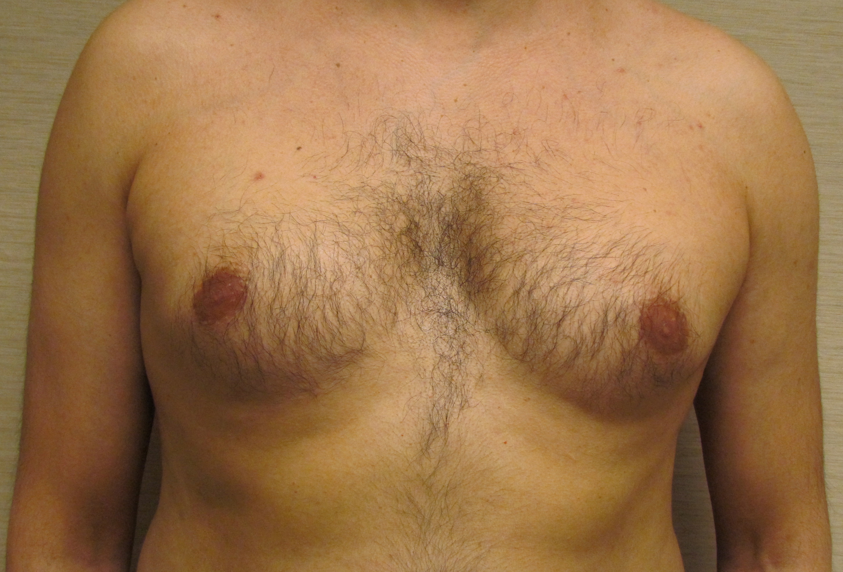Male Breast Reduction (Gynecomastia Surgery) before and after - after