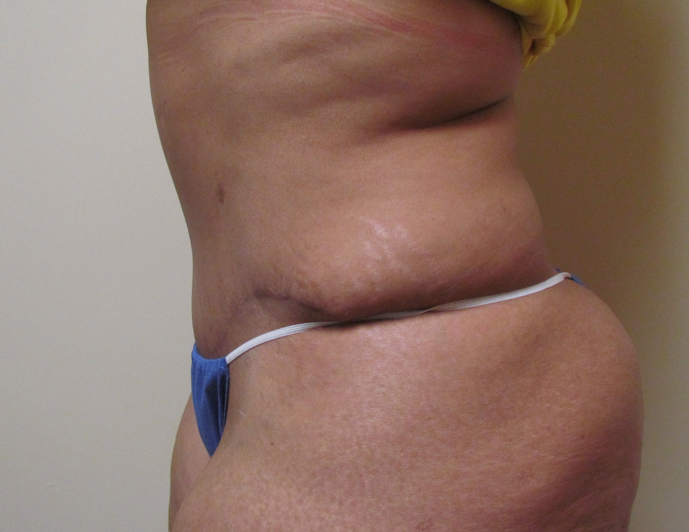 Tummy Tuck with Abdominal Muscle Tightening before and after - after