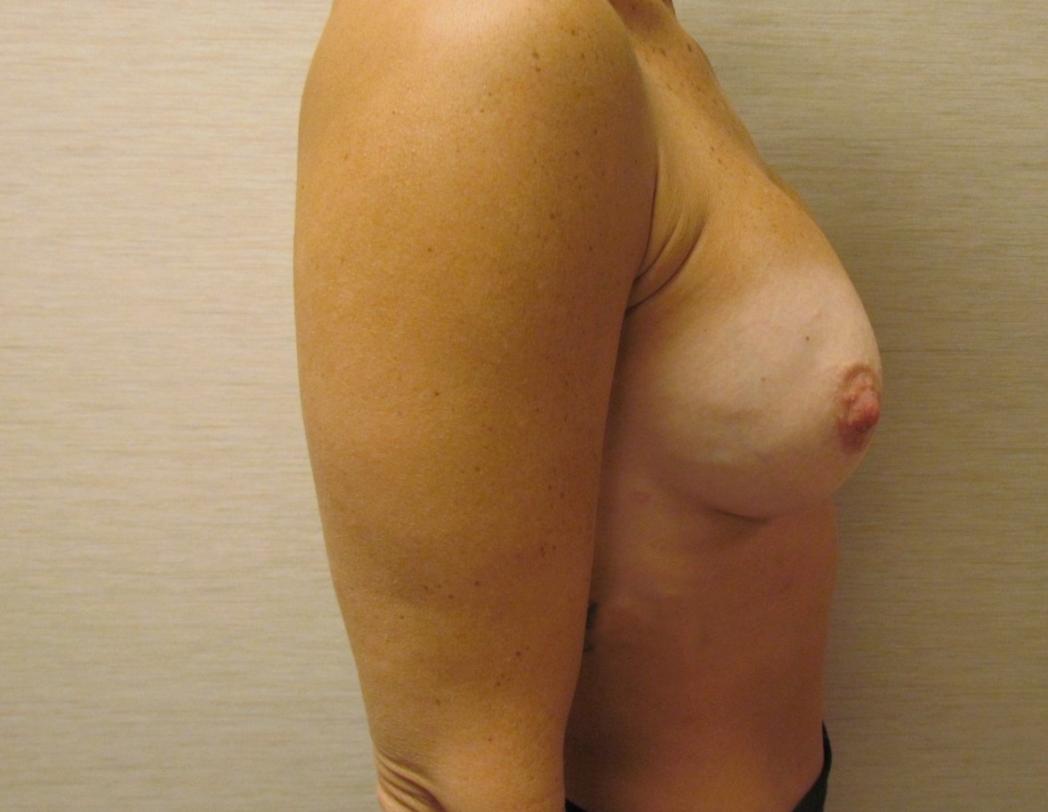 Bilateral Breast Reconstruction using Tissue expansion before and after - after