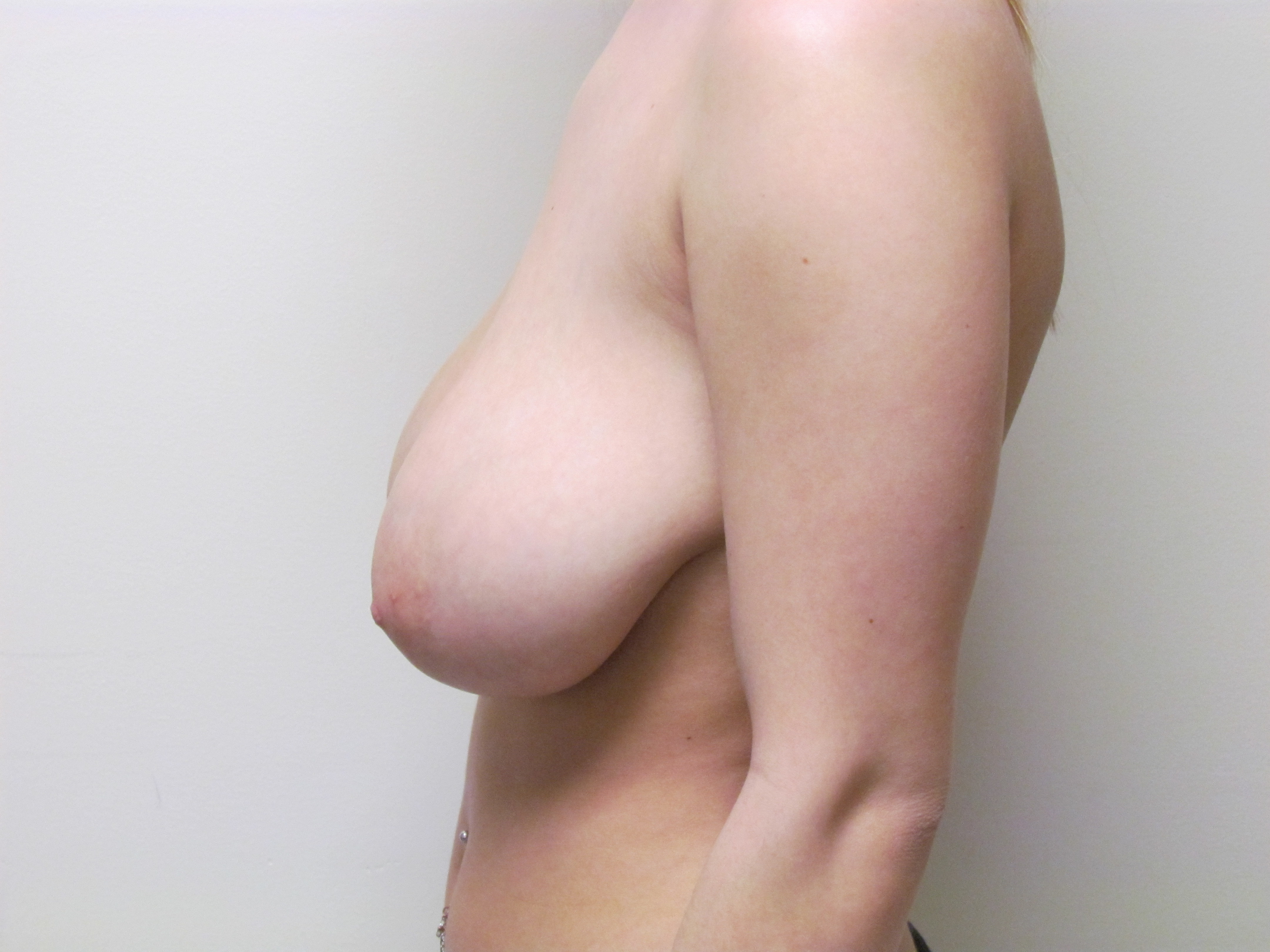 Bilateral Breast Lift before and after - before