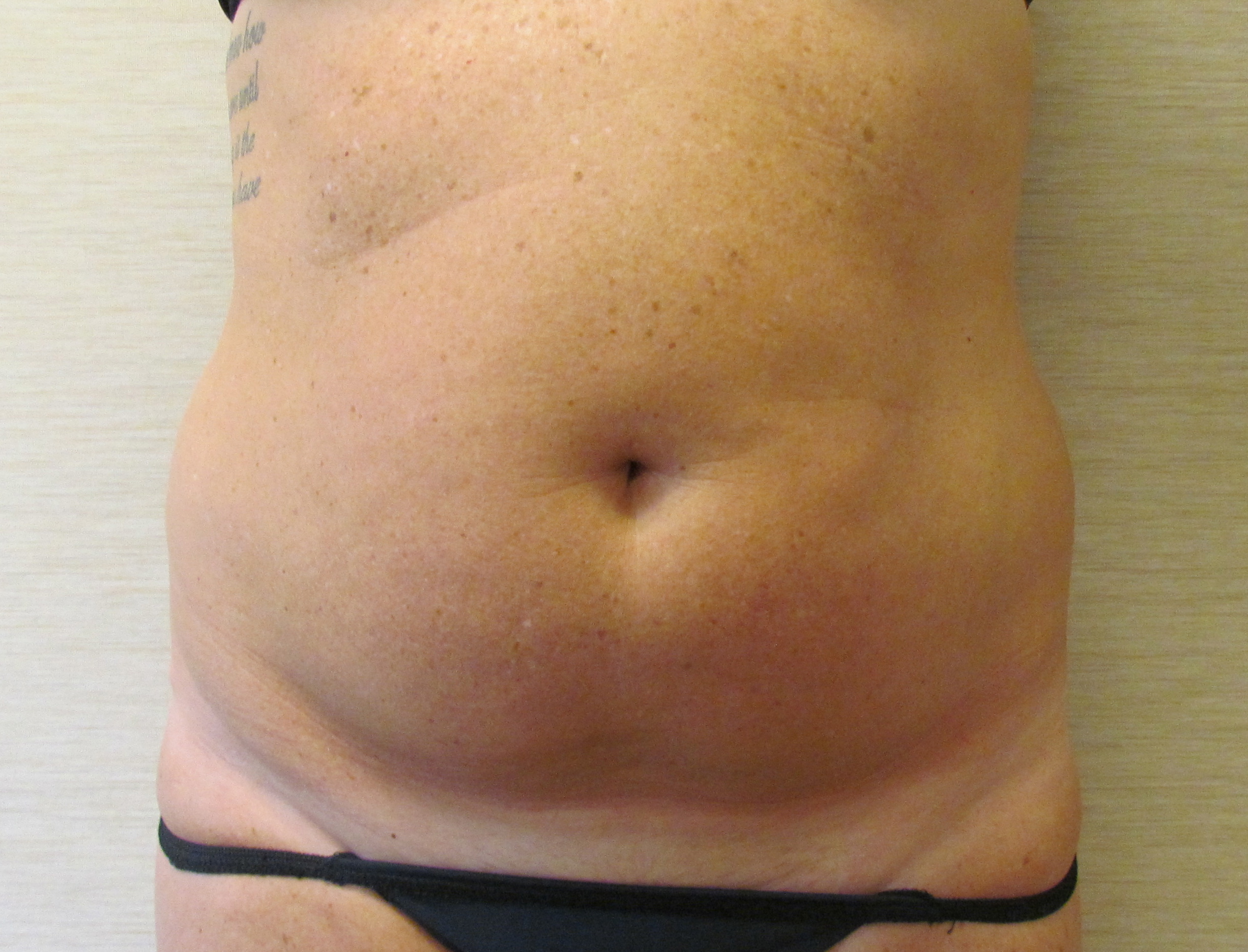 Liposuction before and after - before