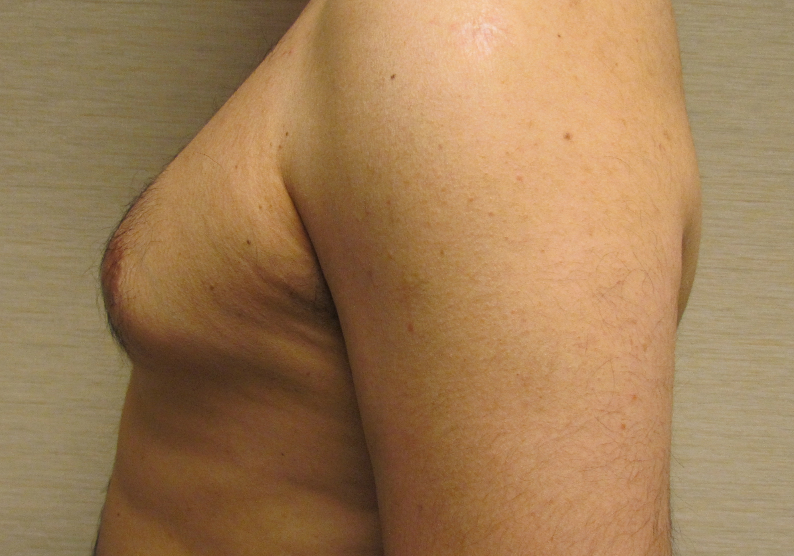 Male Breast Reduction (Gynecomastia Surgery) before and after - before