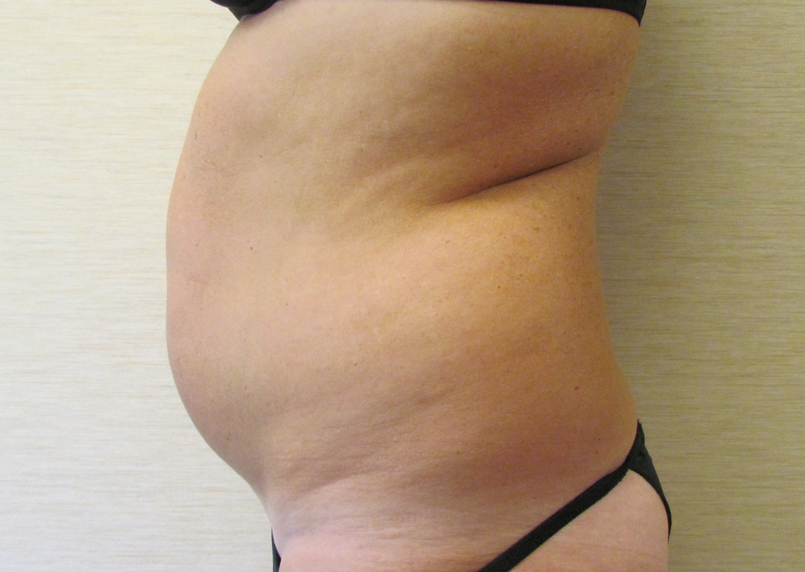 Abdominal Liposuction before and after - before