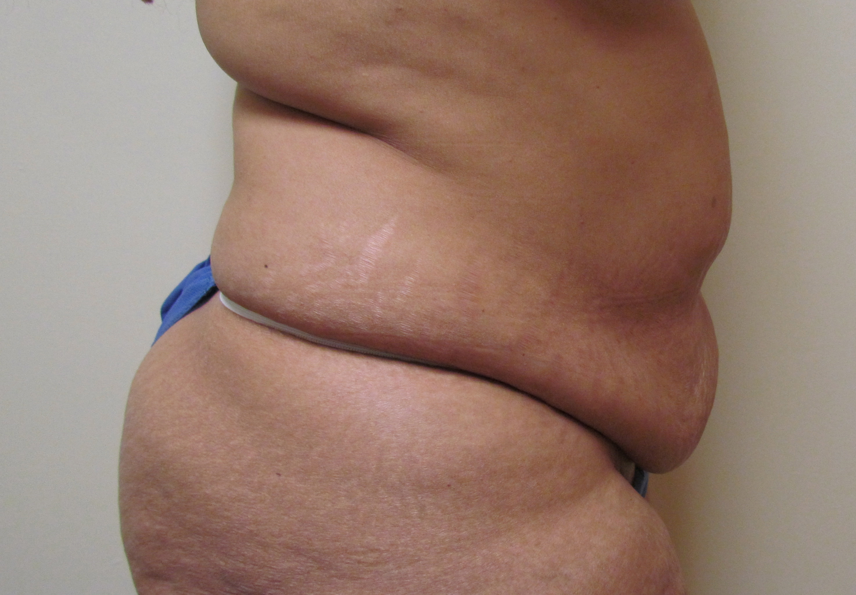 Tummy Tuck with Abdominal Muscle Tightening before and after - before