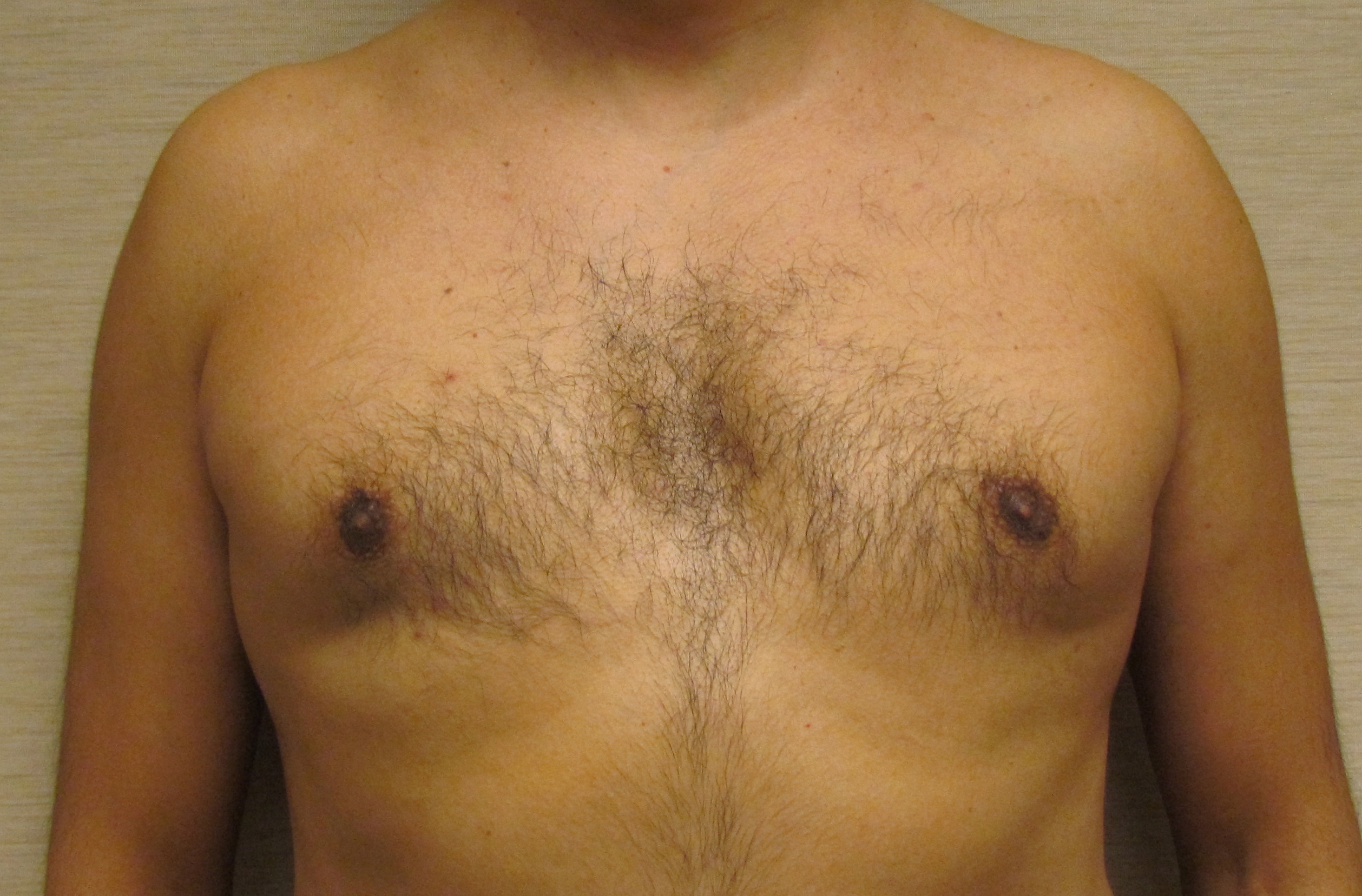 Male Breast Reduction (Gynecomastia Surgery) before and after - before