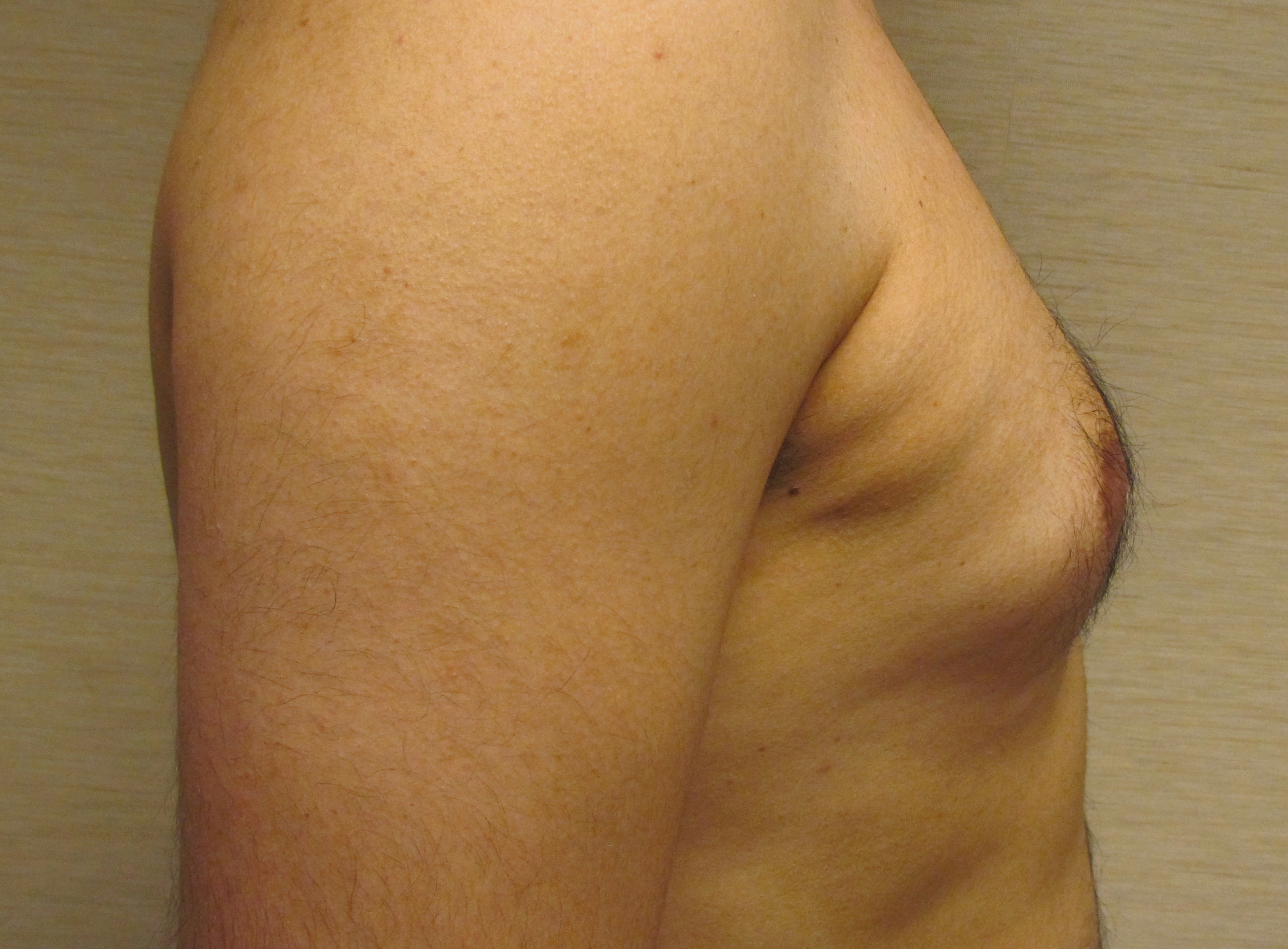 Male Breast Reduction (Gynecomastia Surgery) before and after - before