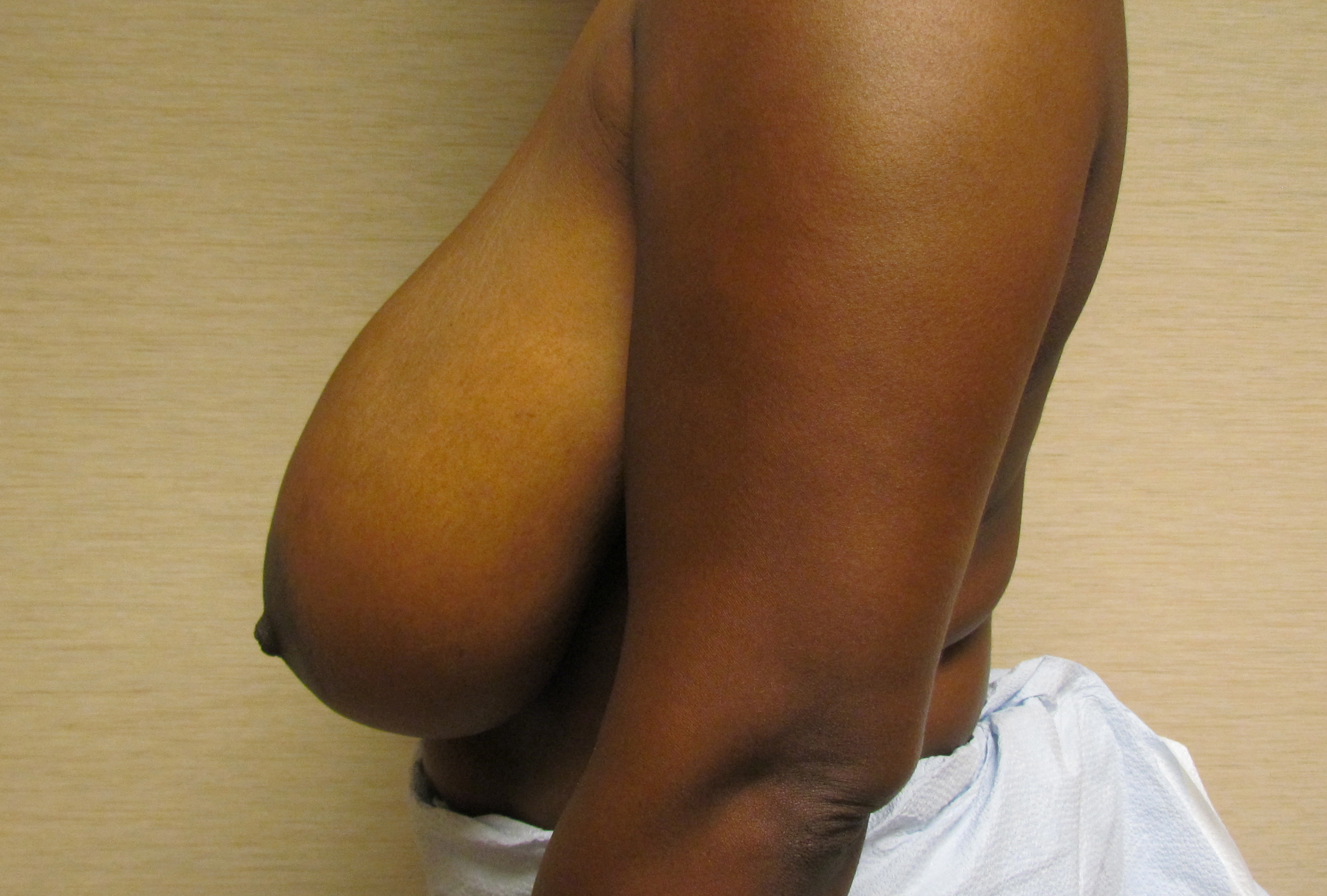 Bilateral Breast Reduction before and after - before