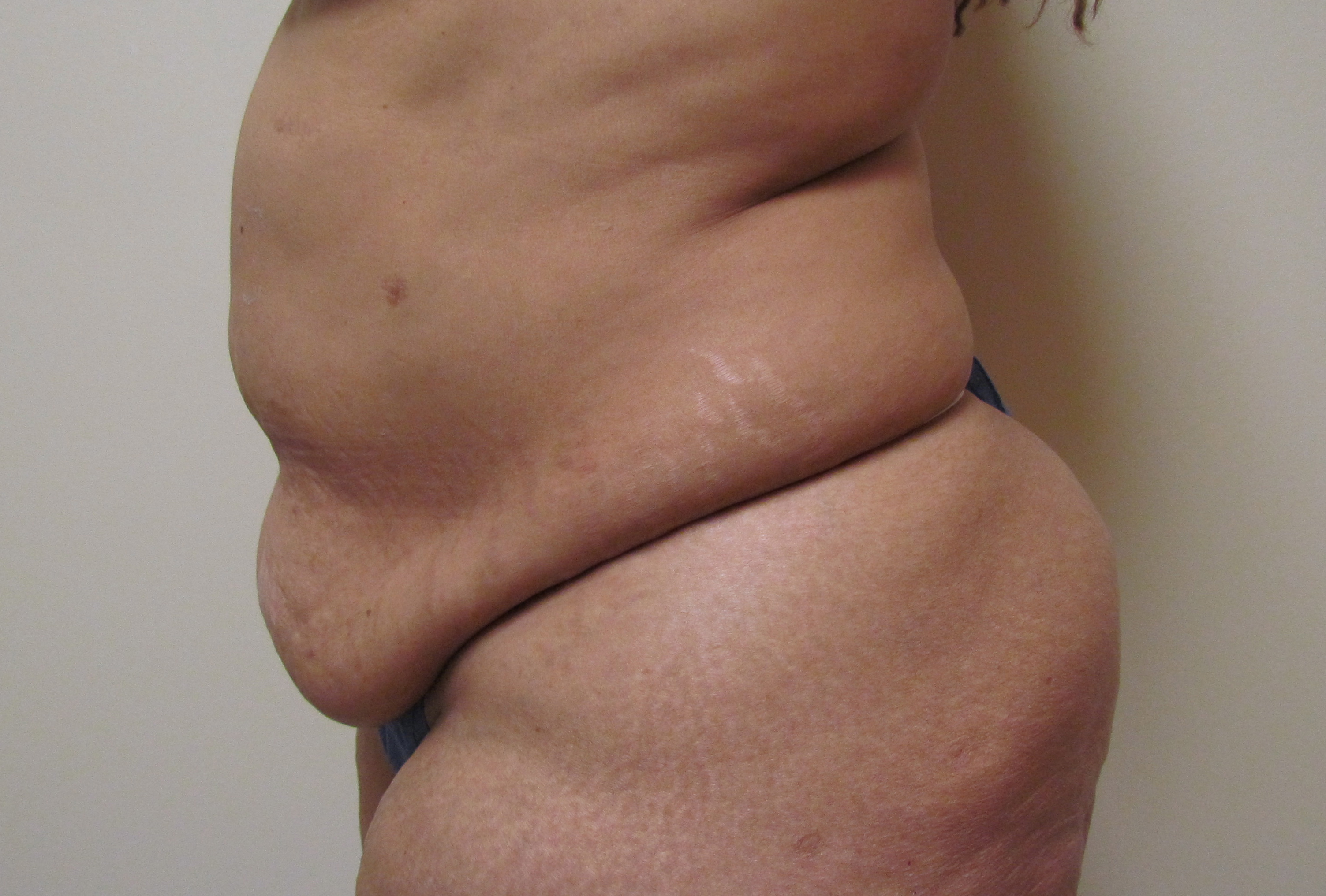 Tummy Tuck with Abdominal Muscle Tightening before and after - before