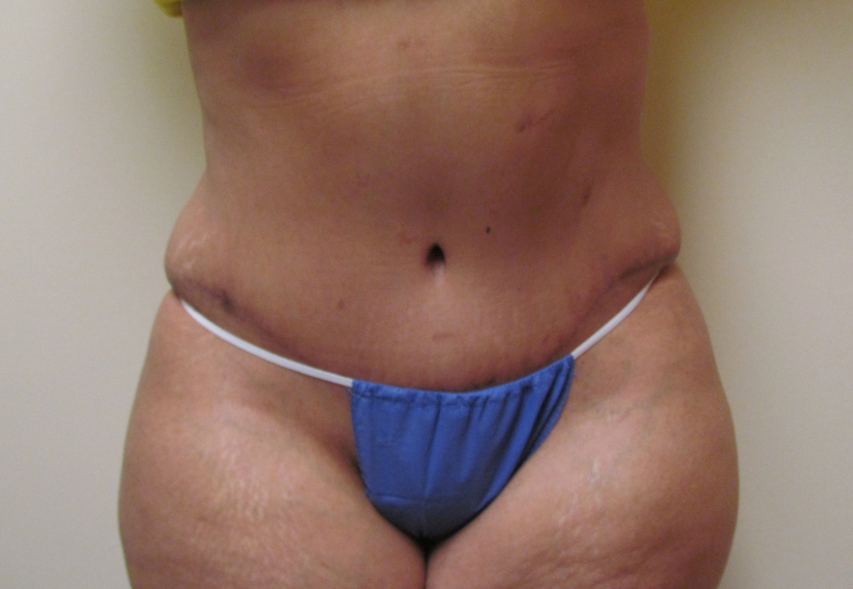 Abdominoplasty (Tummy Tuck) before and after - before