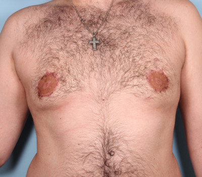 Procedure before and after - after