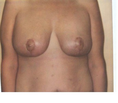 Breast Augmentation before and after - after