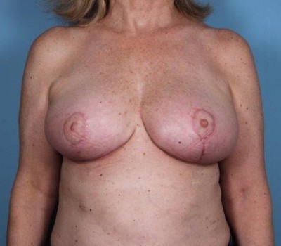 Procedure before and after - after