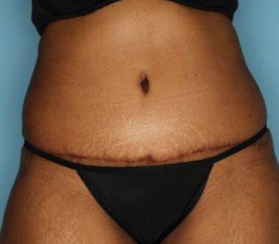 Liposuction before and after - after