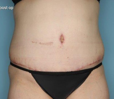 Liposuction before and after - after