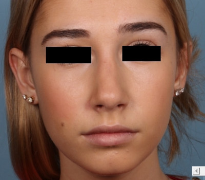 Rhinoplasty before and after - after