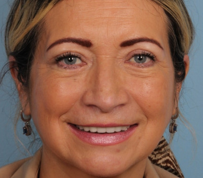 Blepharoplasty before and after - after