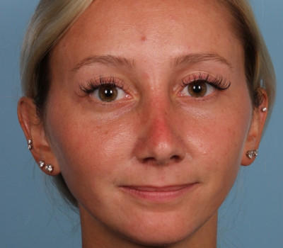 Rhinoplasty before and after - after