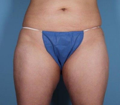 Liposuction before and after - after