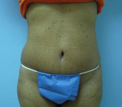 Liposuction before and after - after