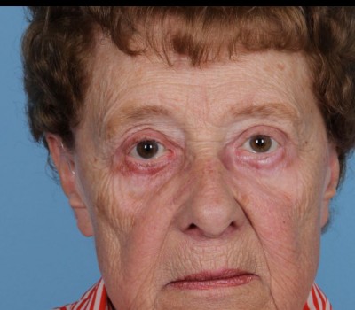 Blepharoplasty before and after - after