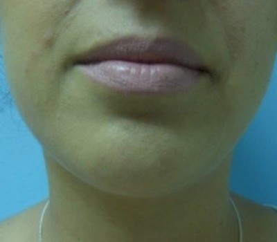 Liposuction before and after - after