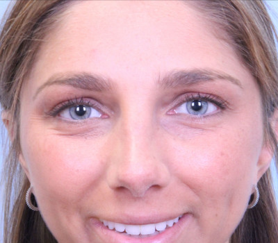 Rhinoplasty before and after - after