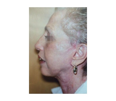 Liposuction before and after - after