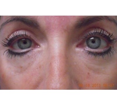Blepharoplasty before and after - after