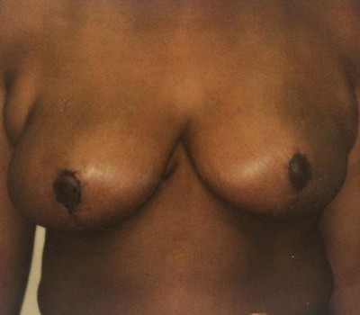 Procedure before and after - after