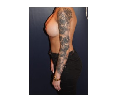 Procedure before and after - after