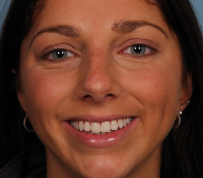Rhinoplasty before and after - after