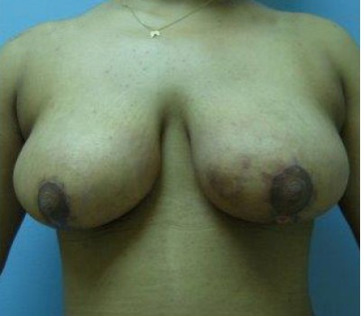 Breast Lift before and after - after