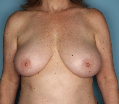 Procedure before and after - before