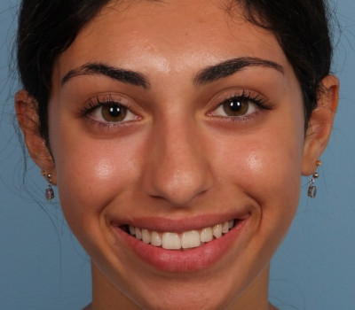 Rhinoplasty before and after - before