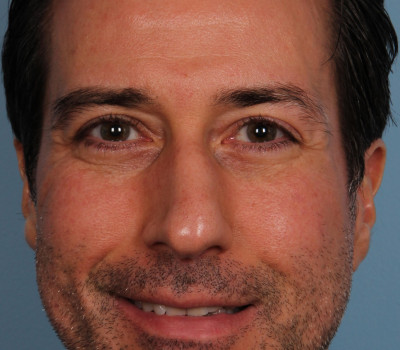 Rhinoplasty before and after - before