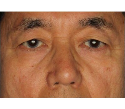 Blepharoplasty before and after - before